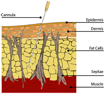 Dermis