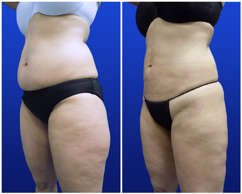 liposuction-jan24-a