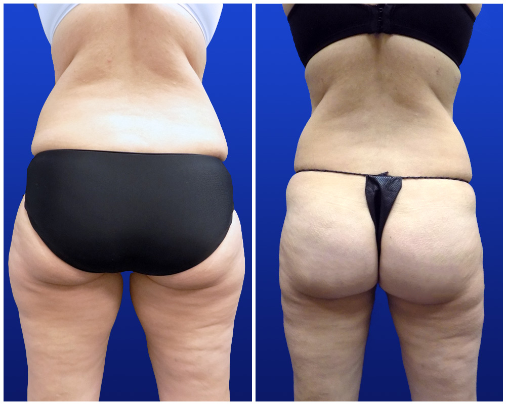 liposuction-jan24-b