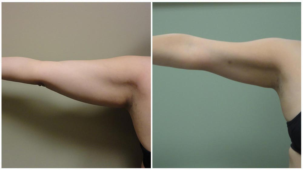 Arm Liposuction Milwaukee 