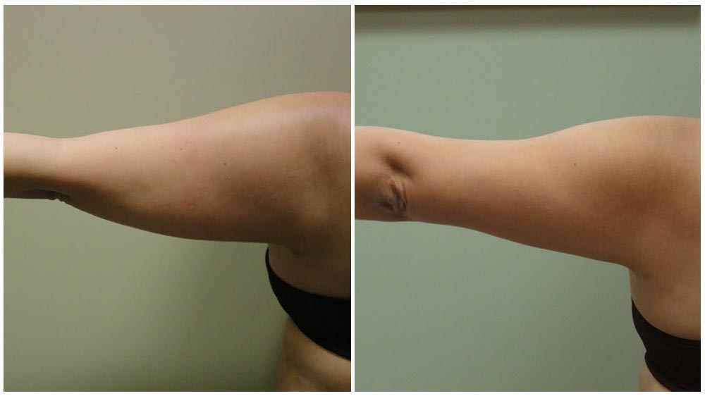 Arm Liposuction Milwaukee 