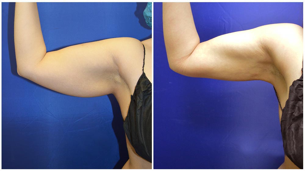 Arm Liposuction Transformation