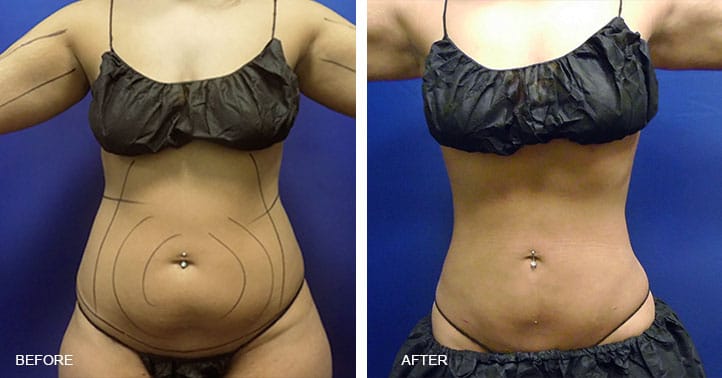 Will Lower Back Liposuction Also Address The Flanks?