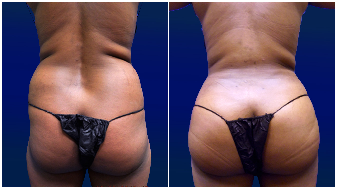 BBL not always A-OK: Why the Brazilian butt lift is one of the