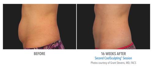 Coolsculpting in Milwaukee