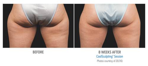 Coolsculpting in Milwaukee