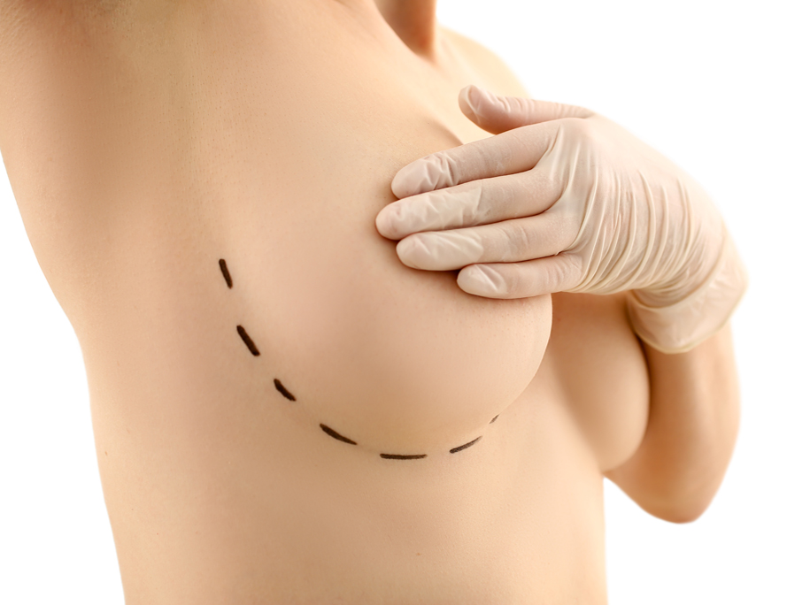 Pros and Cons of Getting Large Implants